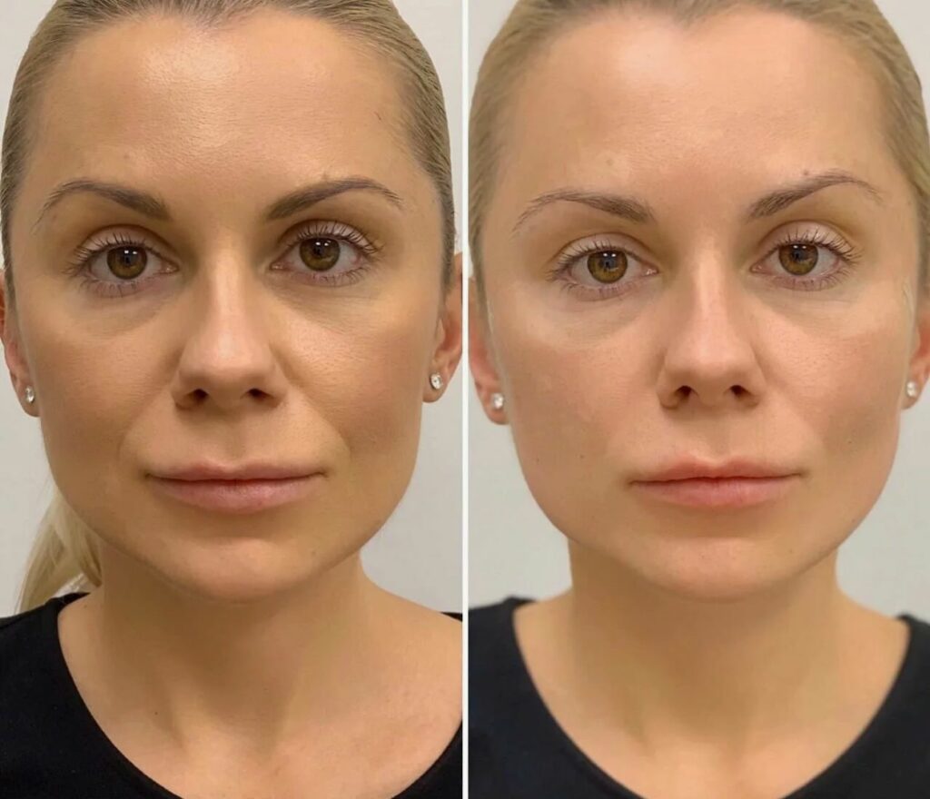 Nucleofill Eyes Advanced Bio-Remodelling treatment for delicate under eye skin.