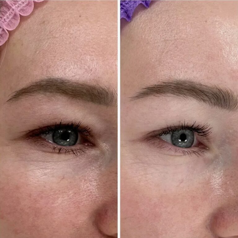 Before and after results of Nucleofill Eyes Advanced Bio-Remodelling