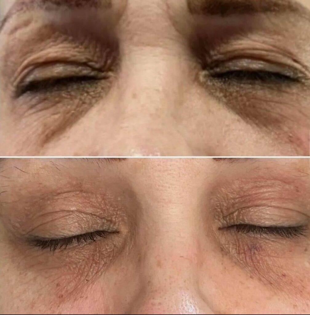 Fine line rejuvenation using Nucleofill Eyes Advanced Bio-Remodelling