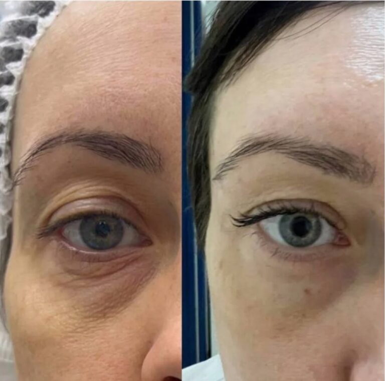 Nucleofill Eyes Advanced Bio-Remodelling injection procedure in clinic