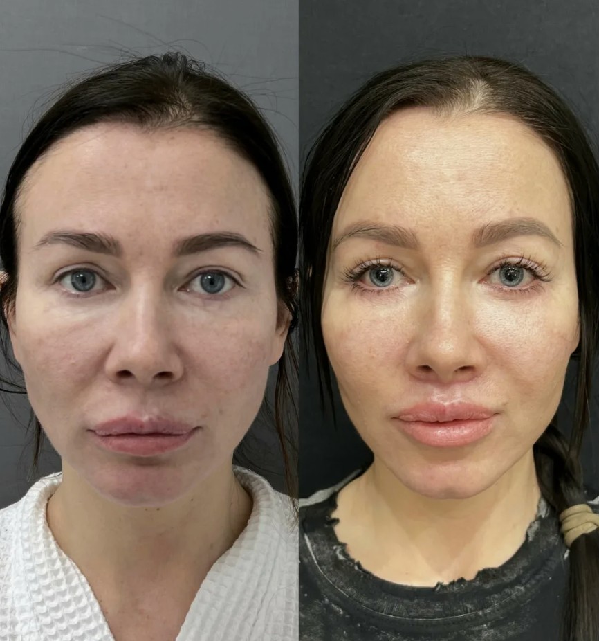 Professional Nucleofill Eyes Advanced Bio-Remodelling in aesthetic clinic.