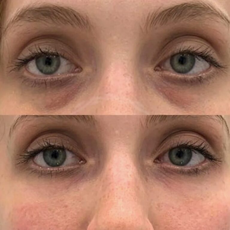 Skin quality improvement with Nucleofill Eyes Advanced Bio-Remodelling