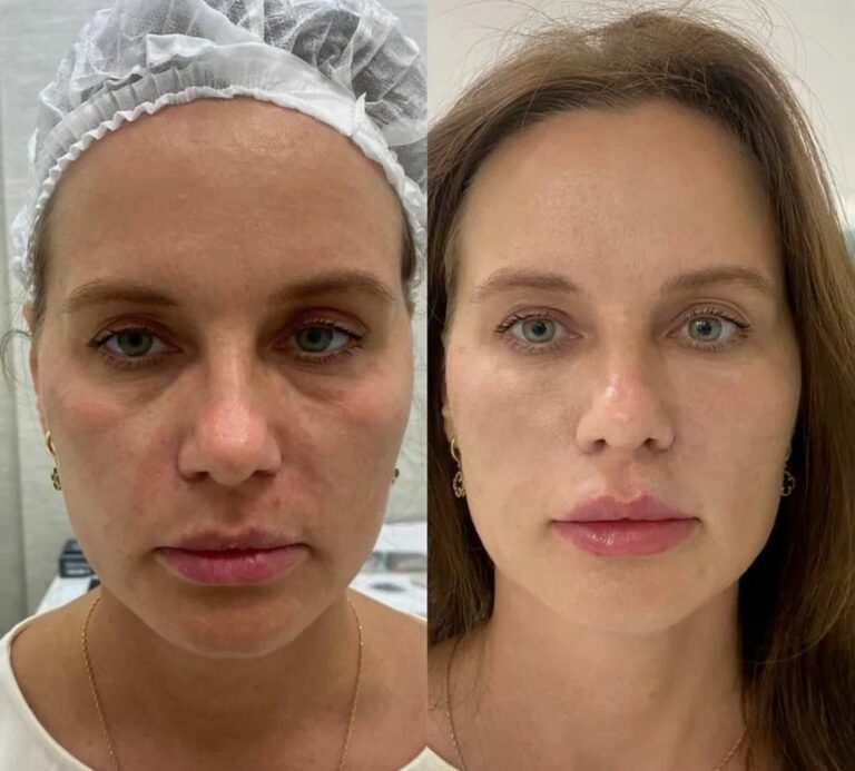 Facial Nucleofill injections to enhance skin quality and hydration.