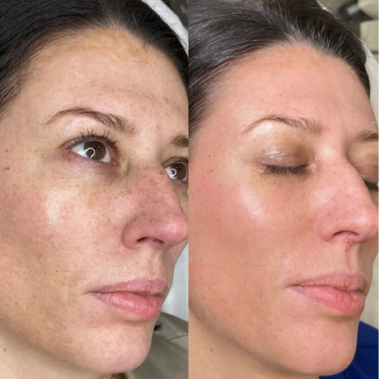 Nucleofill treatment for deep skin rejuvenation and improved elasticity.