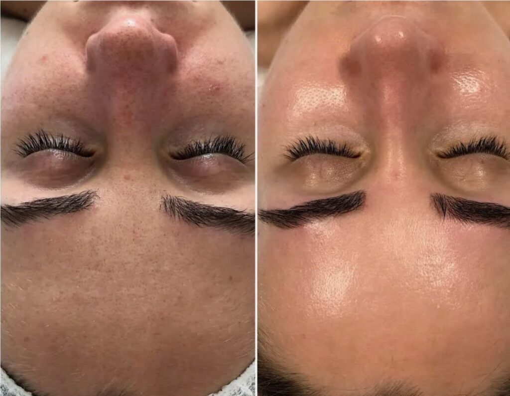 Platinum HydraFacial premium treatment for deep cleansing and hydration.