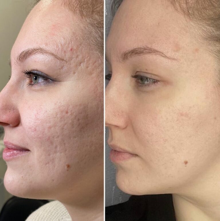 Platinum HydraFacial treatment carried out in a professional aesthetic clinic.