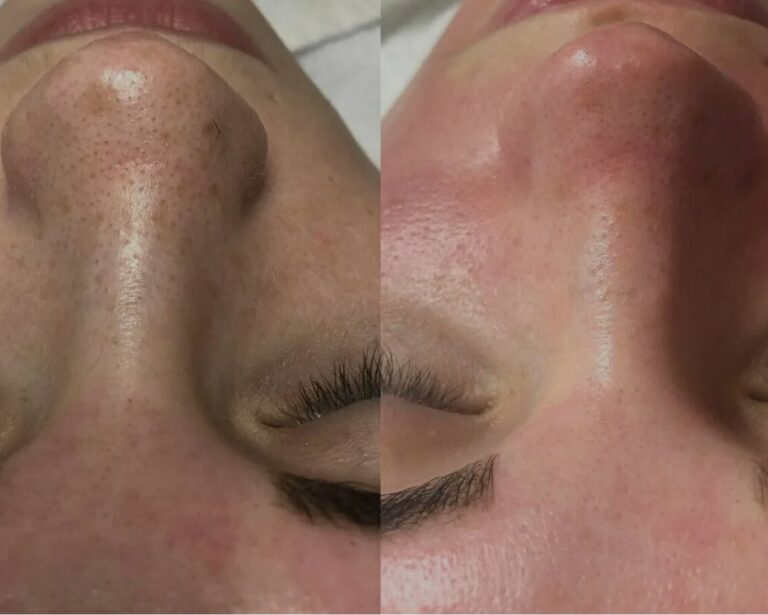 platinum-hydrafacial-skin-hydration