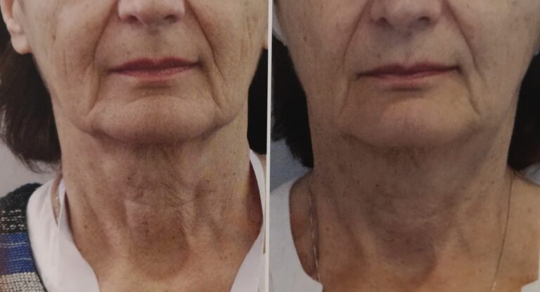 Advanced aesthetic treatment using Profhilo Structura for facial support.