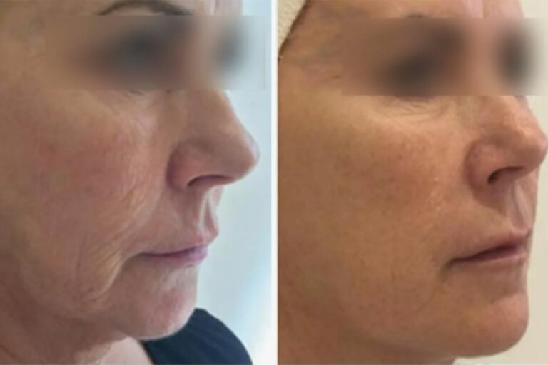 profhilo-structura-before-after-results