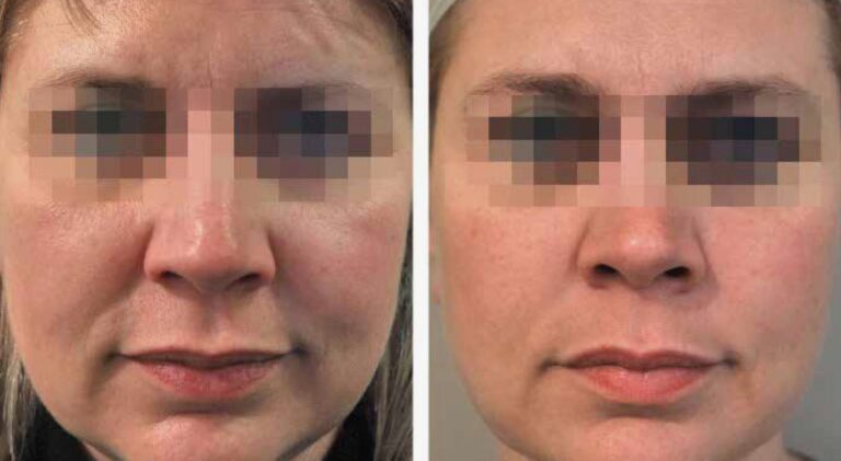 Profhilo Structura injection procedure performed in a medical clinic.