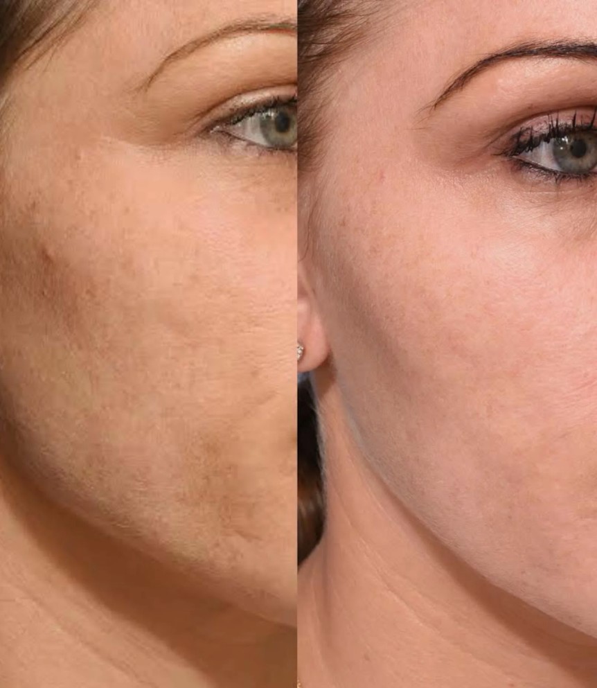 Redensity 1 Skin Booster treatment for deep skin hydration and radiance.