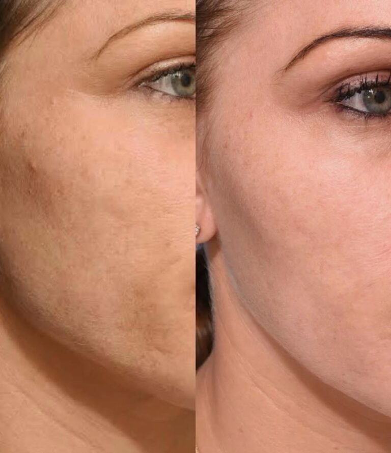 Fine line rejuvenation using Rejuran skin booster