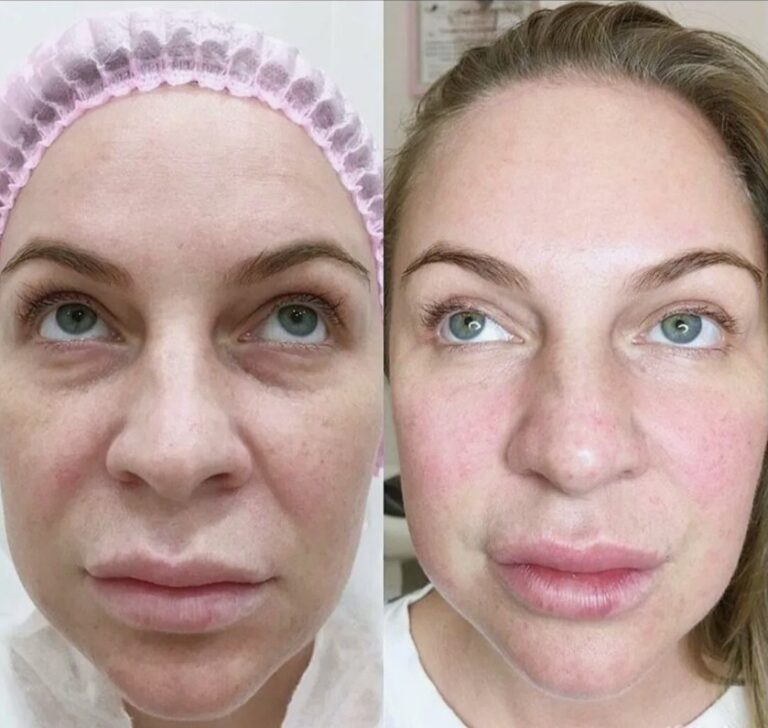 Skin quality improvement with advanced Rejuran treatment