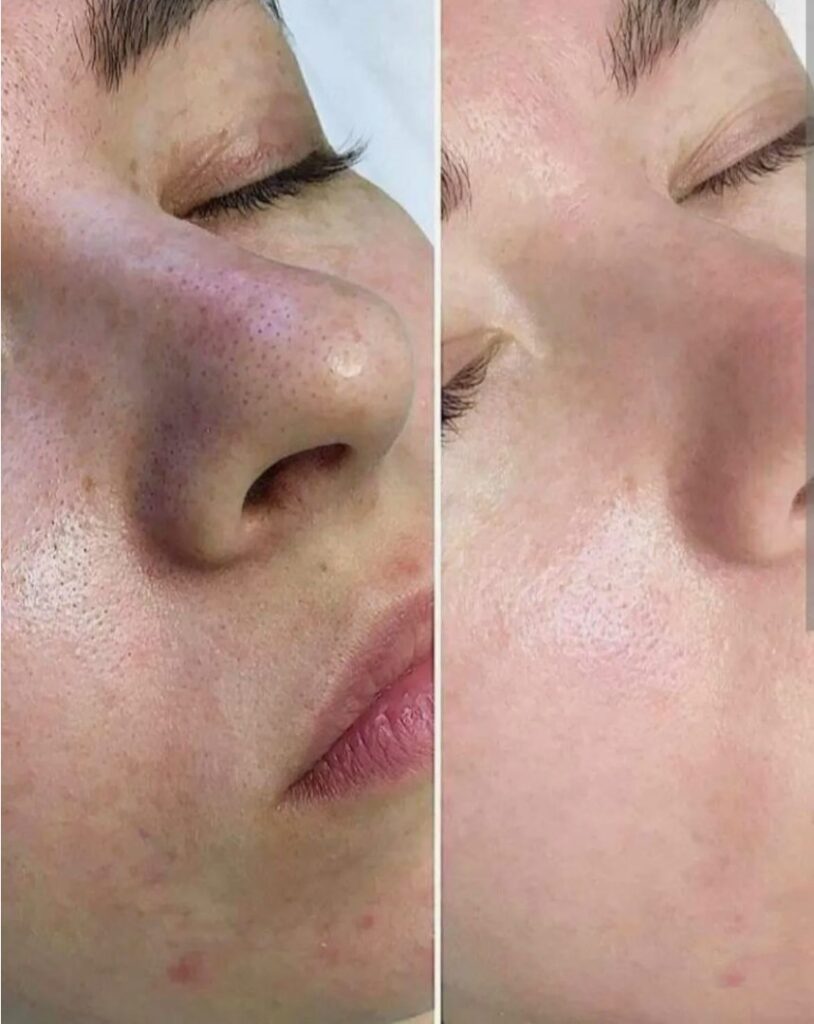 Rejuran treatment for skin rejuvenation and improved texture.