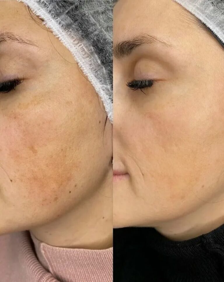 rejuran-skin-repair-therapy