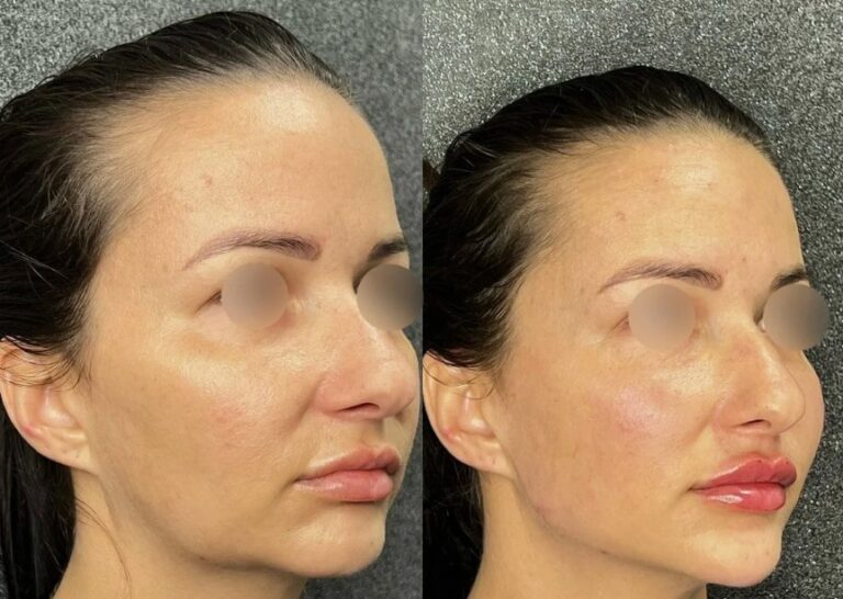 Anti aging skin rejuvenation using Sculptra injectable treatment.