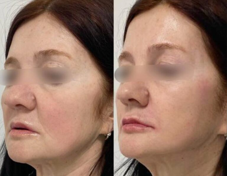 sculptra-before-after-results