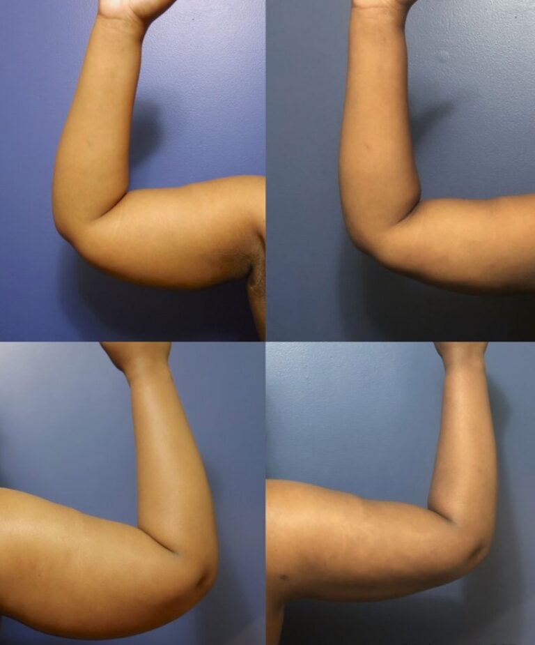 Sculptra Body Treatments carried out in a professional aesthetic clinic.