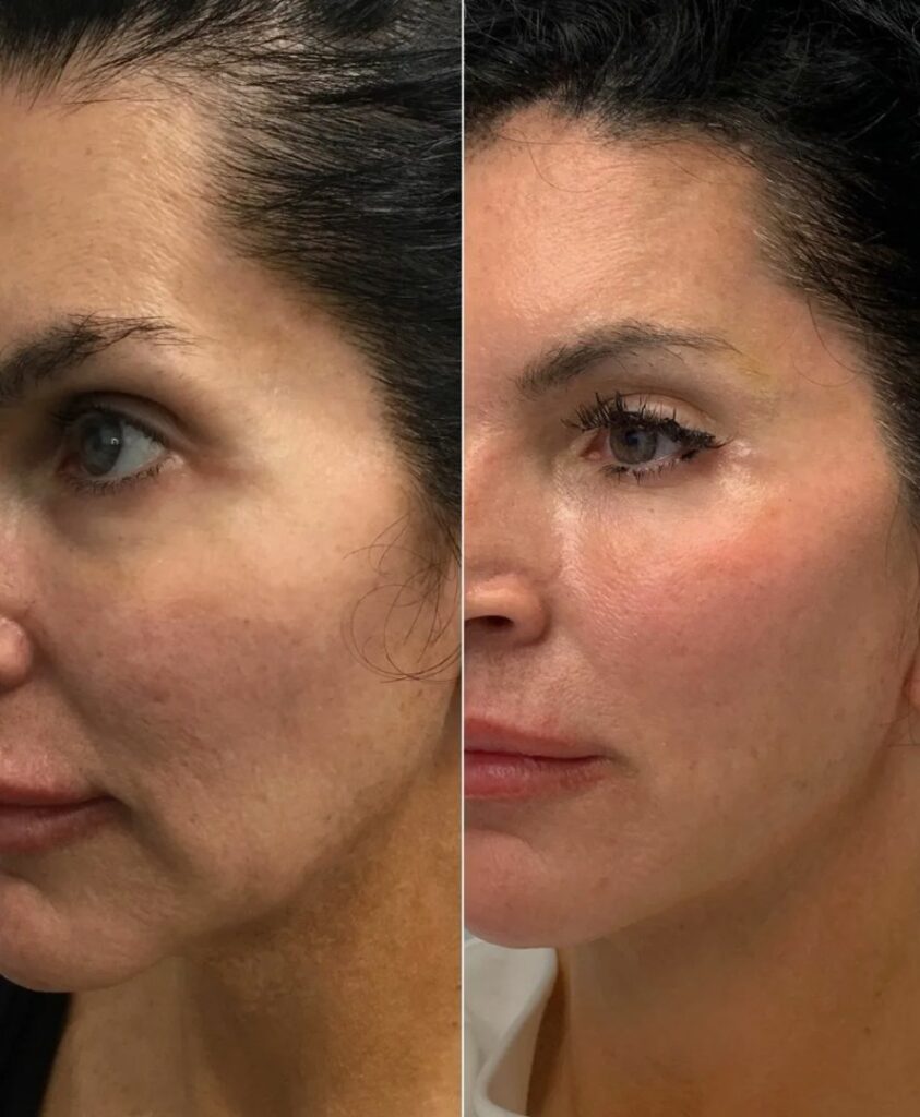 Sculptra treatment to stimulate collagen and improve skin structure.