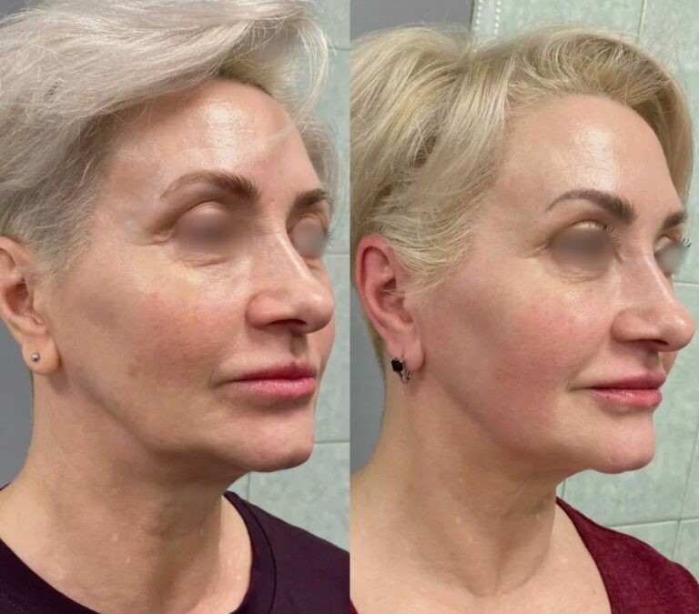Sculptra skin rejuvenation therapy for improved texture and tone.