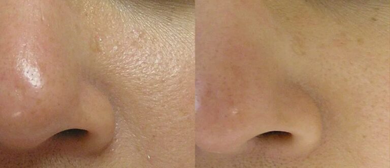 Before and after results of Signature HydraFacial treatment.