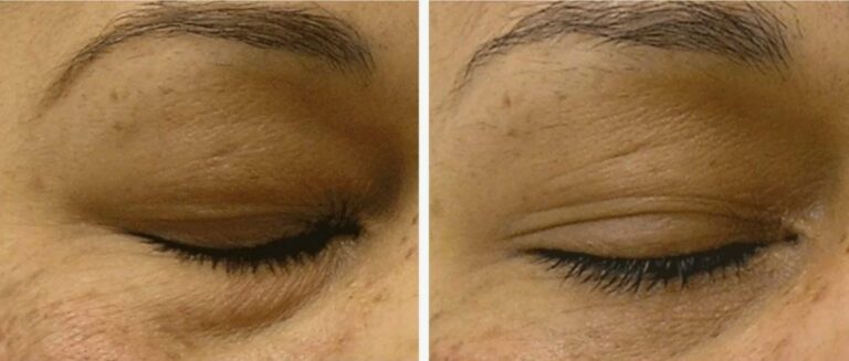 signature-hydrafacial-exfoliation