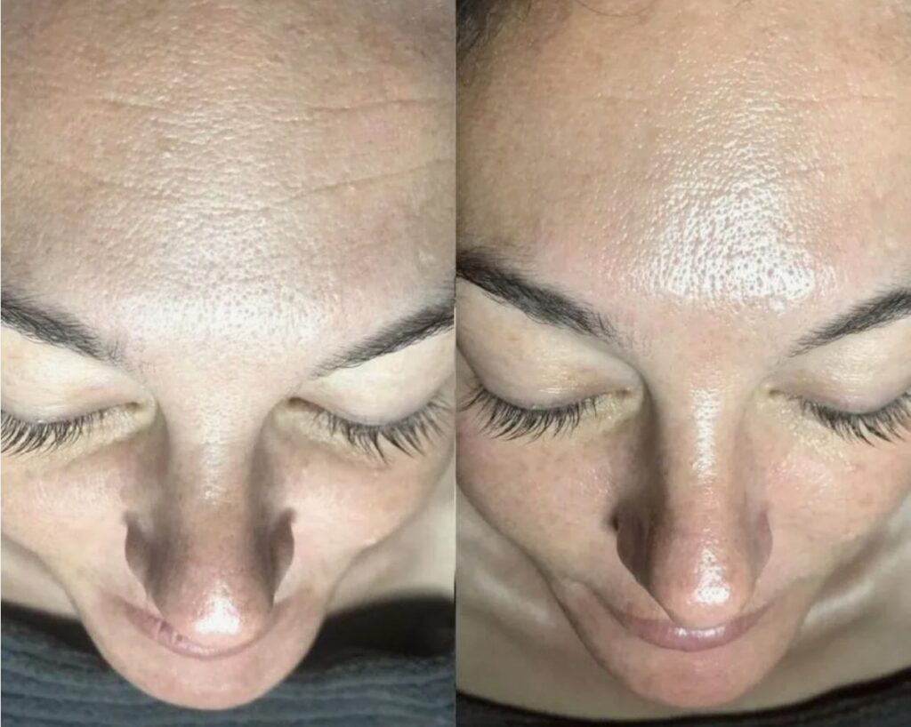 Professional Signature HydraFacial facial treatment in clinic.