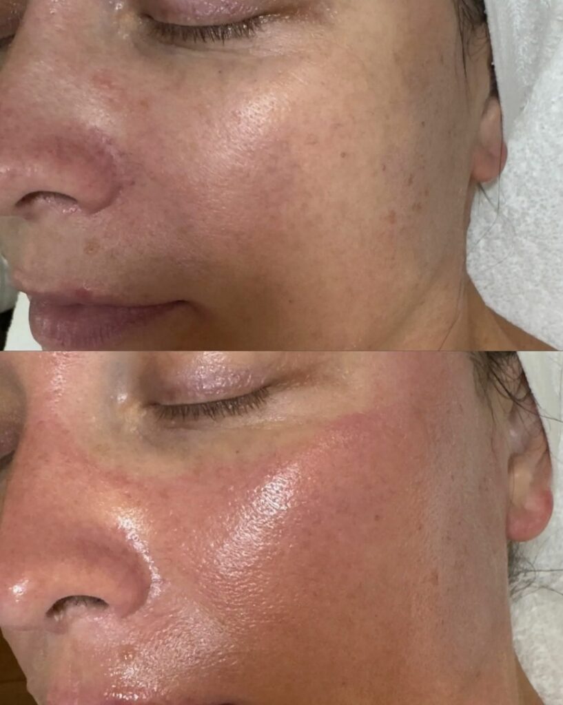 Healthy and refreshed skin after Signature HydraFacial treatment.