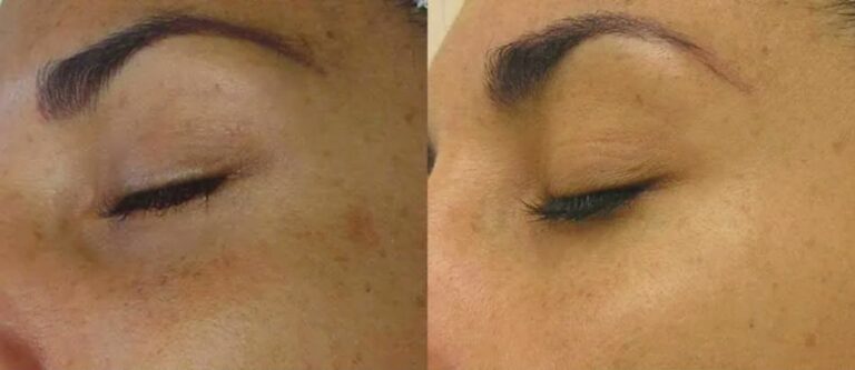 Signature HydraFacial for deep skin cleansing and hydration.