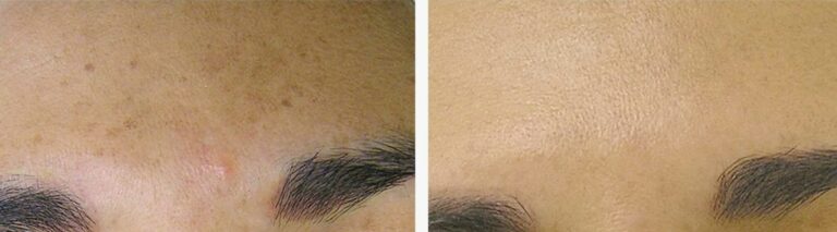 Improved skin hydration and glow with Signature HydraFacial.