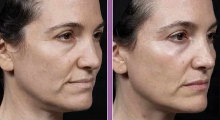 Advanced aesthetic care using Skin Tightening & Saggy Skin Treatments.