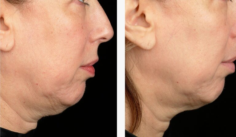 Before and after results of Skin Tightening & Saggy Skin Treatments.