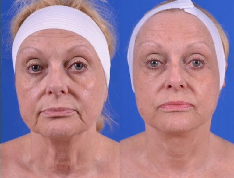 Professional Skin Tightening & Saggy Skin Treatments performed in clinic.
