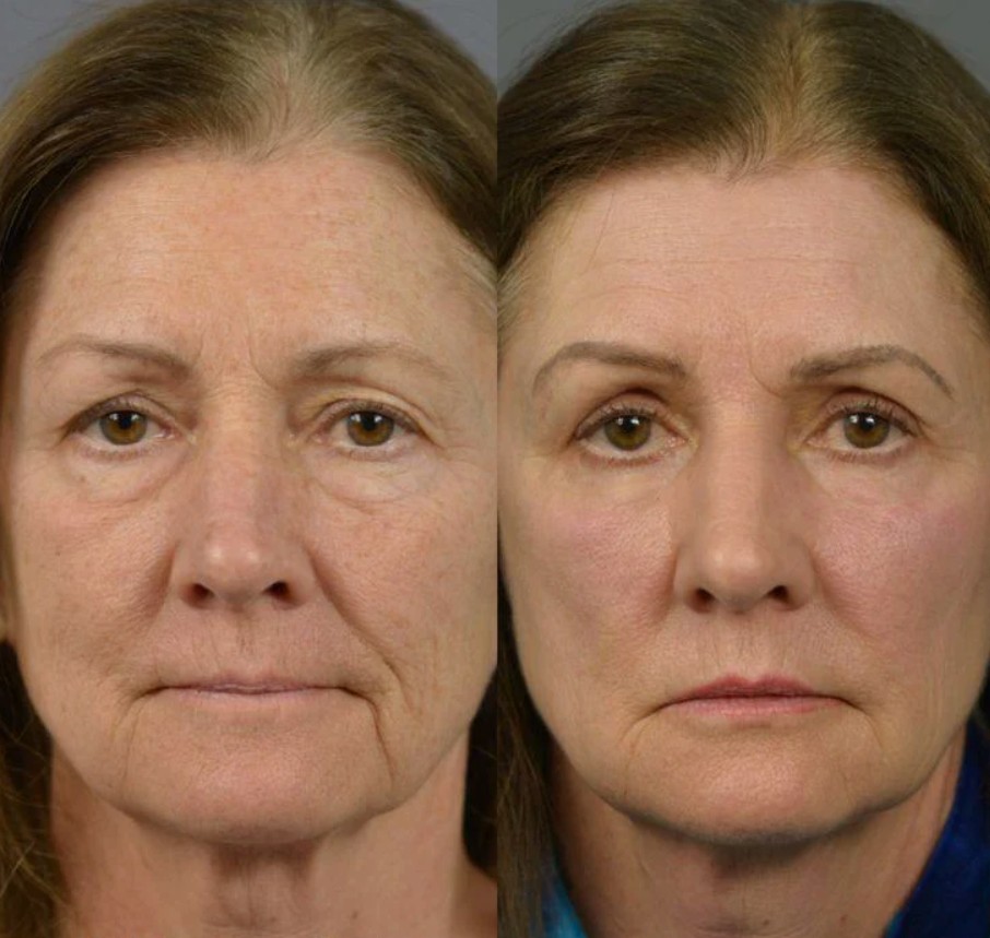 skin-tightening-saggy-skin-treatments-procedure