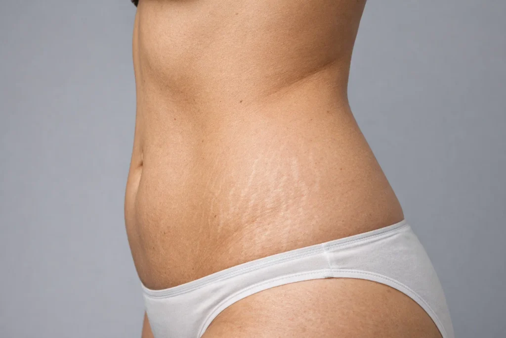 A close-up photo showing natural skin texture and striae patterns against a muted soft grey background.