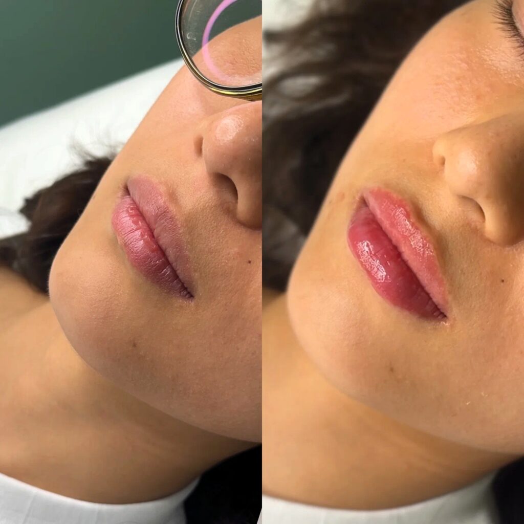 Professional lip filler consultation in London aesthetic clinic showing natural lip assessment before treatment