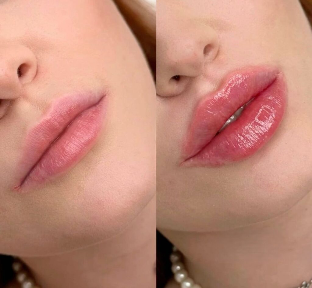 1ml Lip Filler Treatment Cost: Pricing Overview