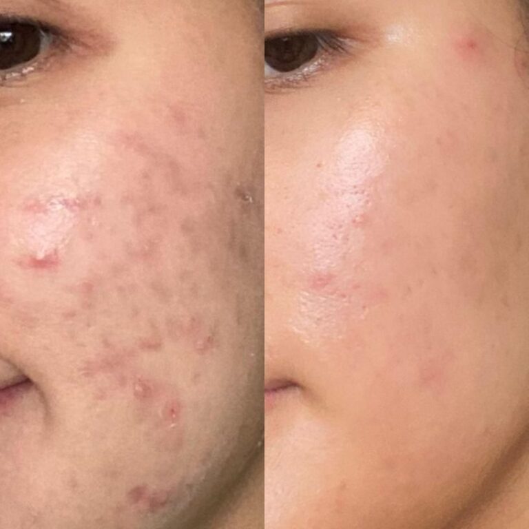 after-acne-treatment-results-2