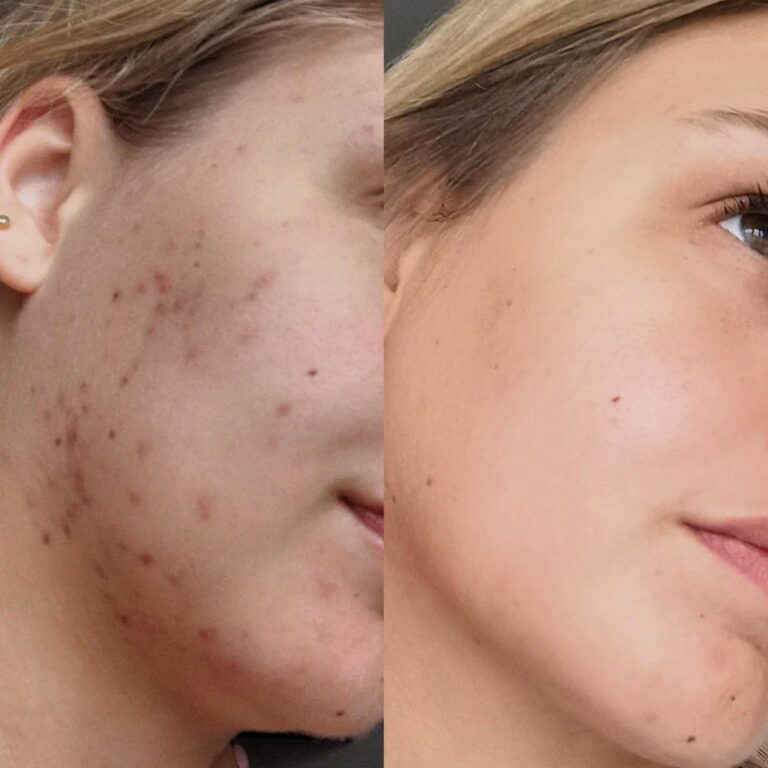 after-acne-treatment-results-3
