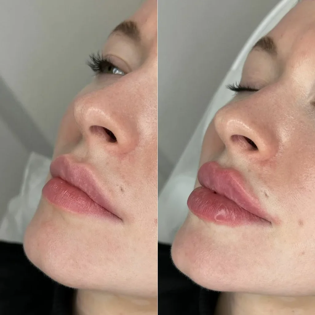 Before and after lip filler comparison in Mayfair showing natural volume enhancement and improved lip symmetry