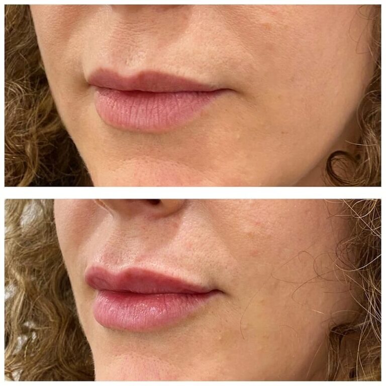 Before and after 0.5ml lip filler treatment showing subtle natural lip enhancement and improved definition
