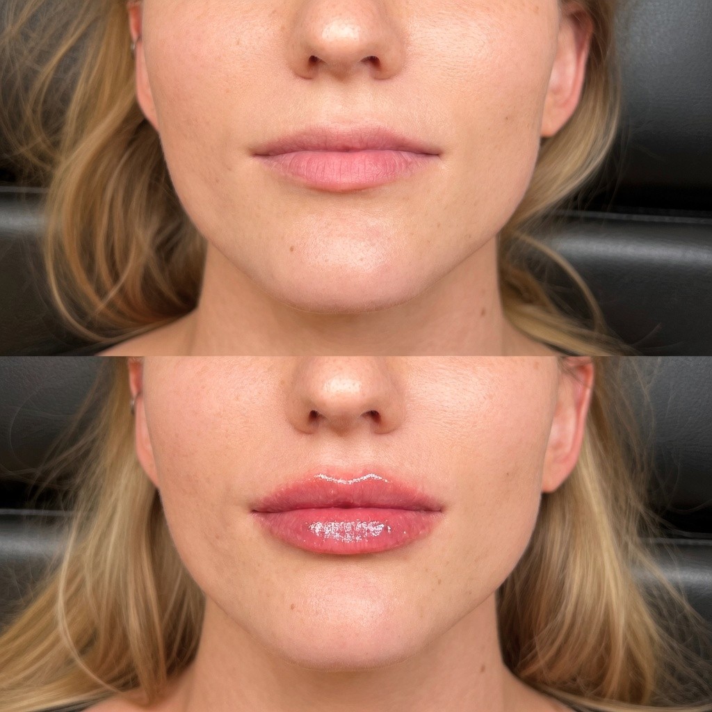 Side-by-side comparison of lips before and after 1ml filler treatment showing natural volume enhancement and definition