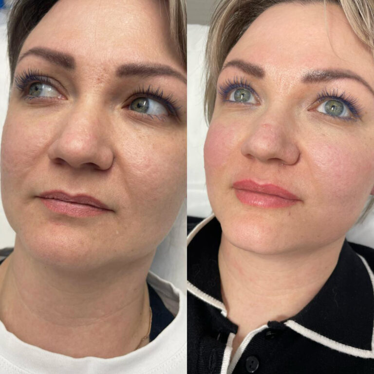 Before and after comparison showing natural lip enhancement results from hyaluron pen treatment