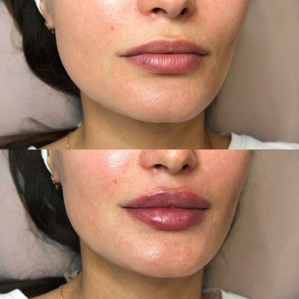 Woman showing natural lip enhancement results after Juvederm filler treatment with improved volume and definition