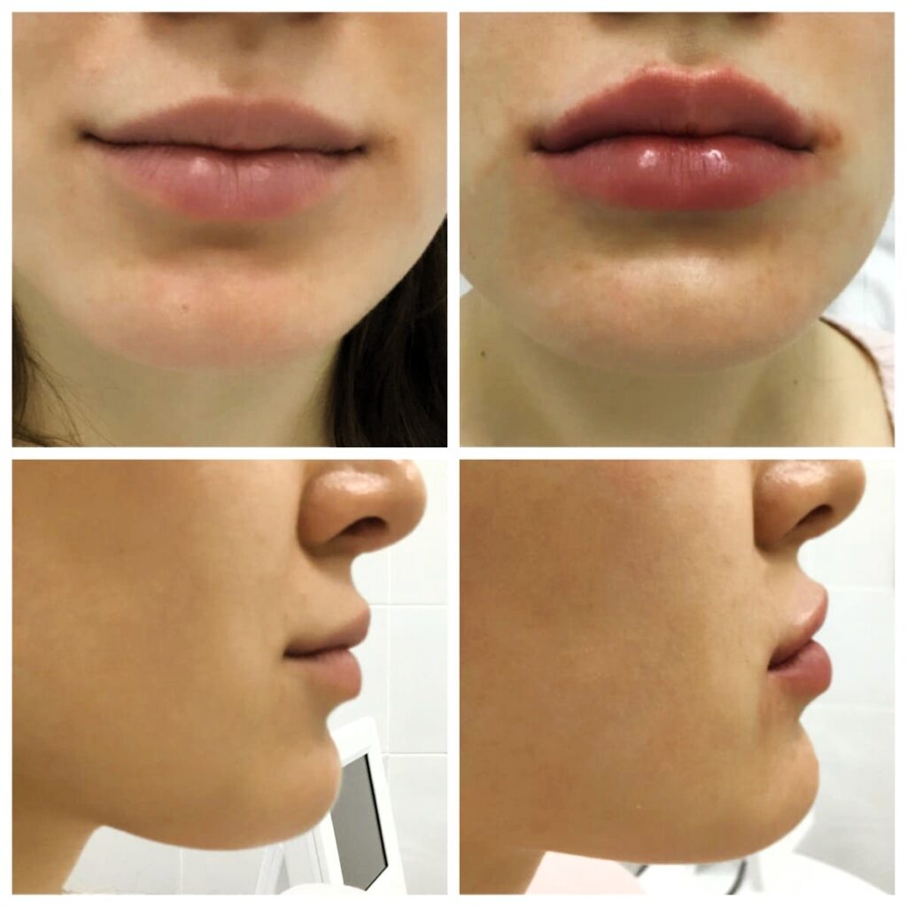 Split comparison showing natural lip enhancement transformation with improved volume and definition after filler treatment