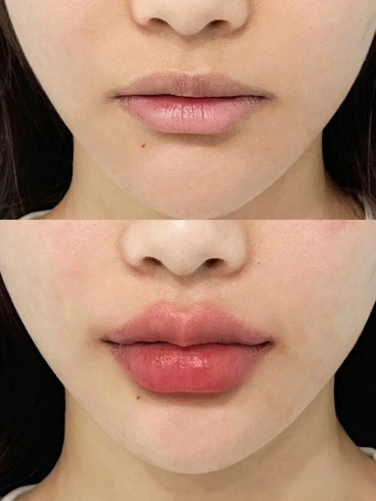Woman's face showing lip enhancement results, comparing natural lips with fuller augmented lips after hyaluronic acid filler treatment