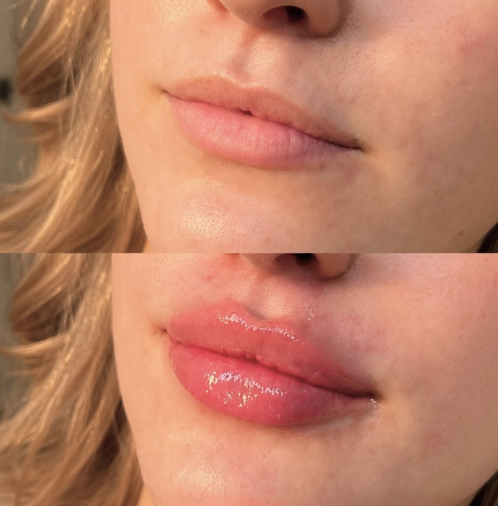 Natural lip enhancement showing multiple benefits including improved volume, definition, and hydration