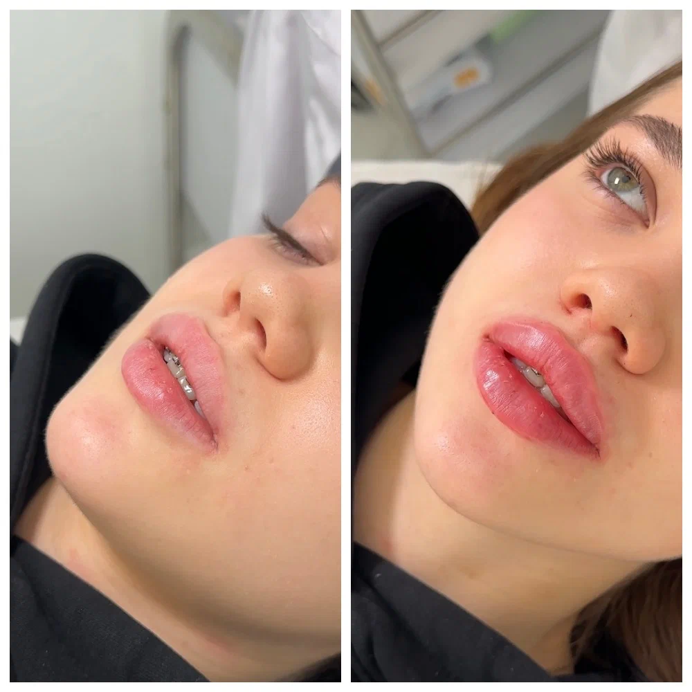 Butterfly lip filler benefits demonstrated through natural enhancement and refined lip architecture