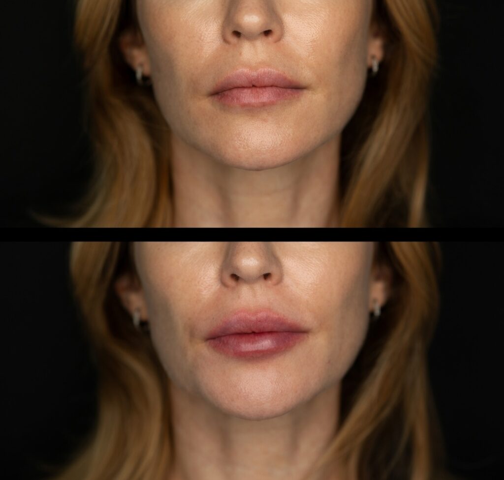 Benefits of Lip Augmentation