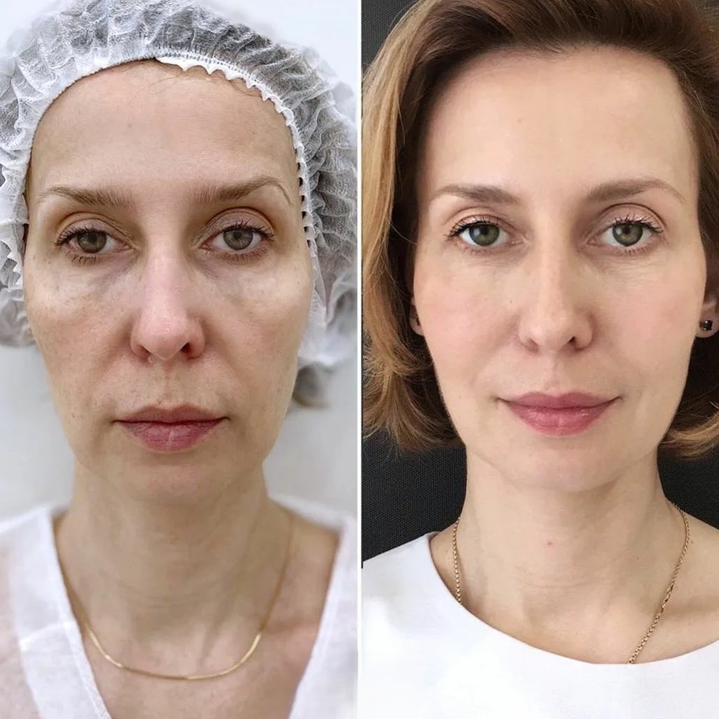 Before and after comparison showing facial volume restoration and wrinkle reduction with hyaluronic acid fillers